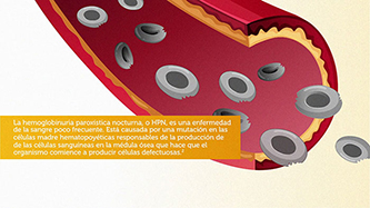 El proceso hemolítico en la HPN