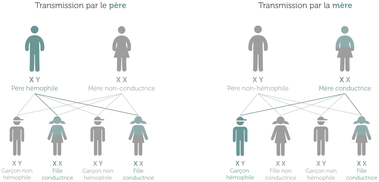 Transmission génétique de l'hémophilie